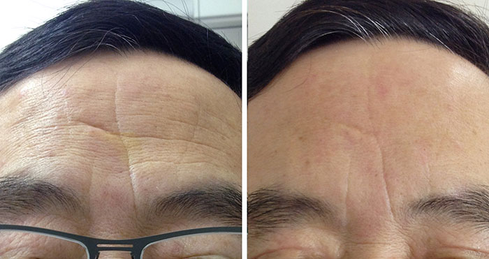 Dermal Fillers remove wrinkle \u0026 facial lines | Lip ...
